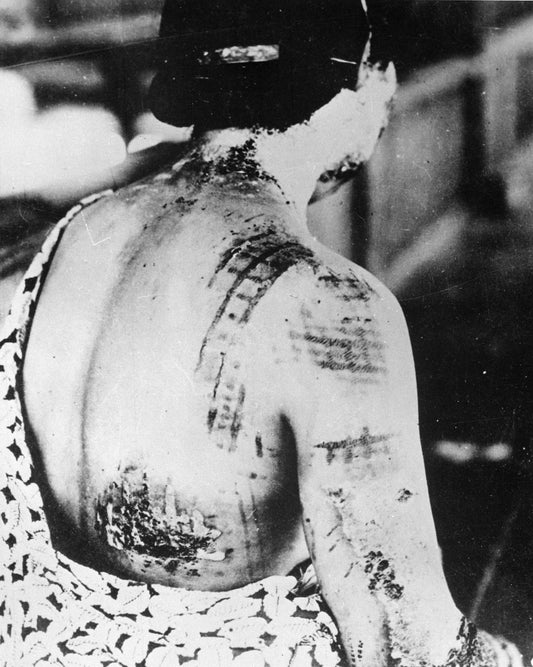 Burns On Body From Atomic Bomb Glossy Poster Picture Photo Print Banner  Conversationprints